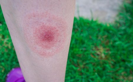 Lyme-kór tünetek és megelőzés