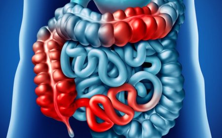 Crohn-betegség: Tünetek, diagnózis és kezelési lehetőségek