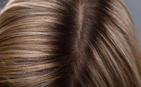 Ezeket a gyógynövényeket használd korpás fejbőrre