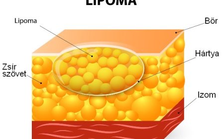 Lipóma: A jóindulatú zsírdaganat