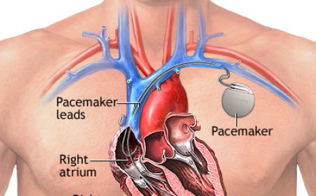 A pacemaker: A szívritmus szabályozásának életmentő eszköze