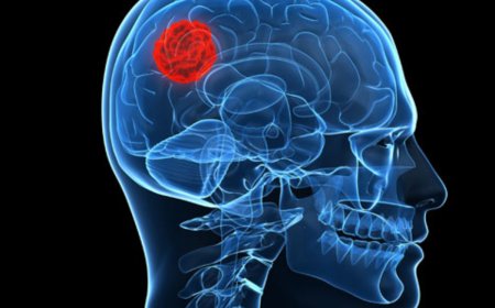 Az agydaganat: Tünetek, diagnózis és kezelés