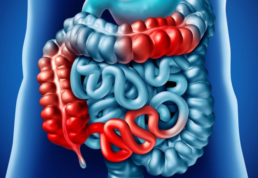 Crohn-betegség: Tünetek, diagnózis és kezelési lehetőségek