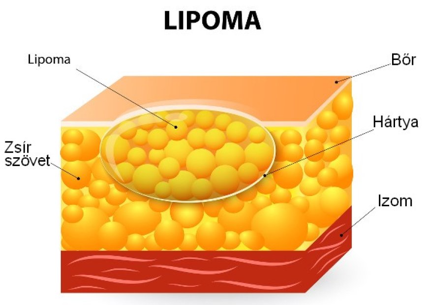 Lipóma: A jóindulatú zsírdaganat