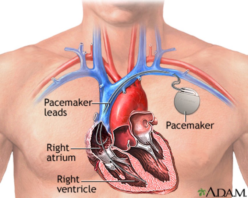 A pacemaker: A szívritmus szabályozásának életmentő eszköze